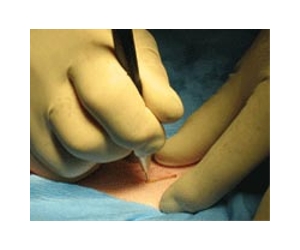 Singapore expertise pioneers quick and scarless surgery