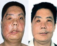 Two years on, face transplant patients can smile: study