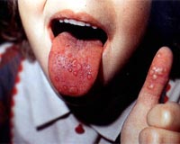 China says no cover-up in disease outbreak