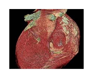 Using magnets to help prevent heart attacks