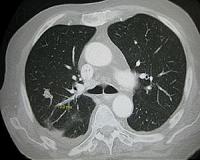 Physicists reveal random nature of metastasis