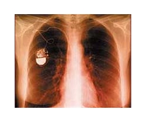 Researchers find security flaws in sensors for heart devices